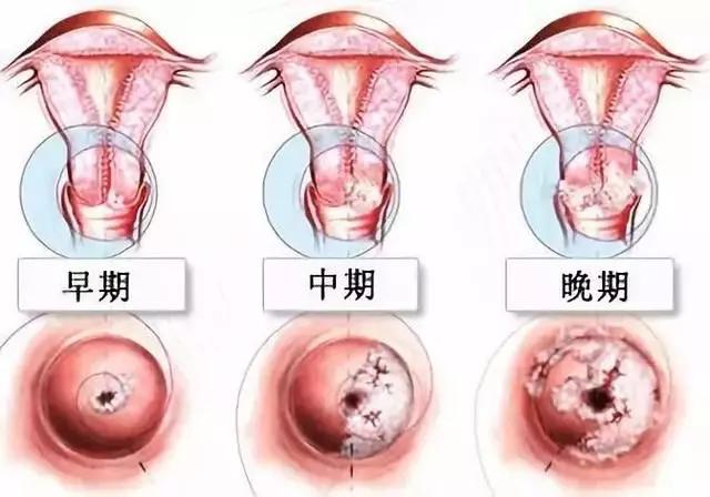 宫颈癌最早分期至2025年的研究进展概览